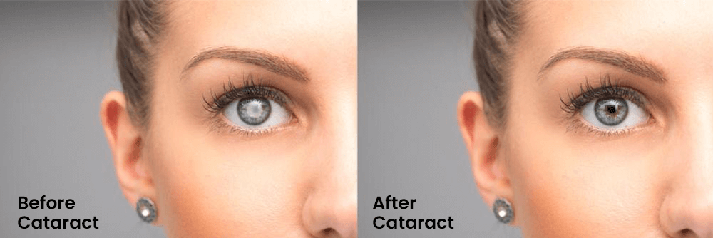 Before and After of Cataract Surgery