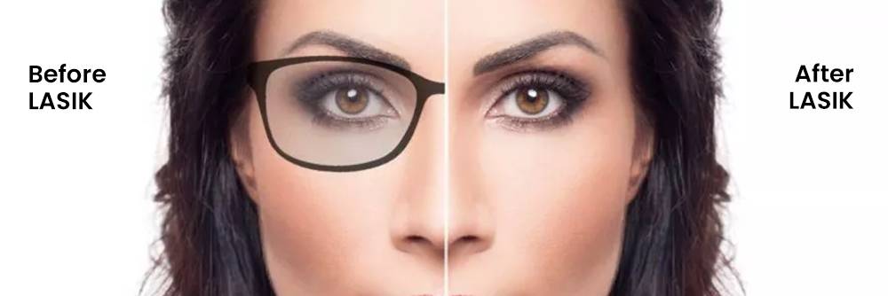 Before and After of Lasik Surgery